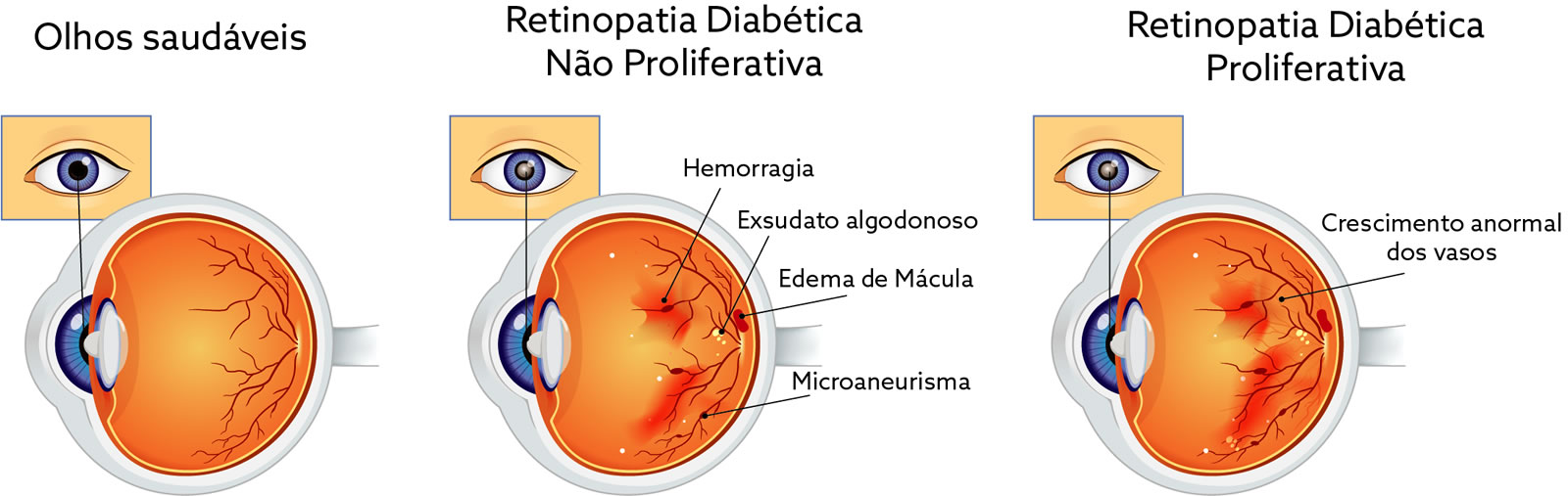 Infografico Retinopatia Diabetica