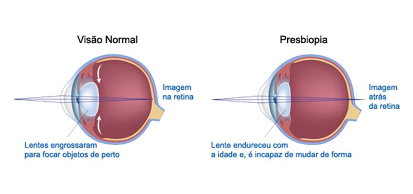 Retina Presbiopia